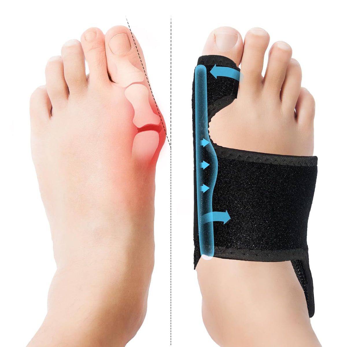 Nighttime Adjustable Bunion Corrector, Splint - Big Toe Straightener