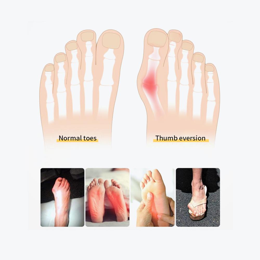 Soft Bunion Corrector with Gel Splint, Cushioned Pad Separator